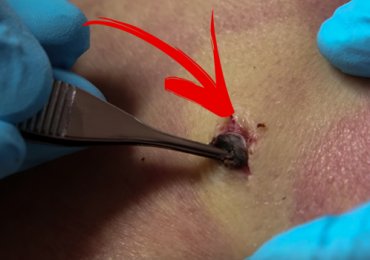 Old Dilated Pore of Winer Removal
