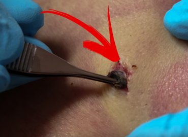 Old Dilated Pore of Winer Removal