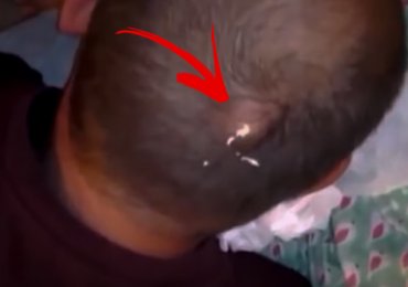 Pus Cyst Explosion