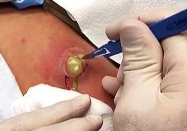 10 Year old Big pimple cyst removed 