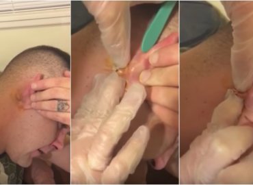 15 Year Old Cyst Explosion from ear