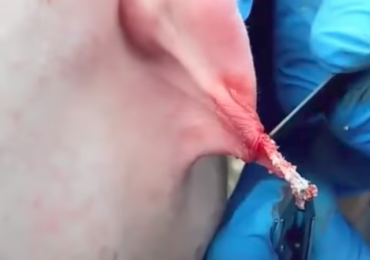 A Big Cyst Popping on the ear
