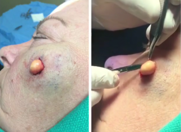 A Cyst Is Removed From A Woman’s Face