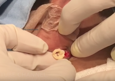 A Cyst that’s Pretty Fly for a Shy Guy