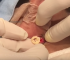 A Cyst that’s Pretty Fly for a Shy Guy