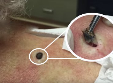A giant blackhead extracted in an 85 y.o accompanied by her daughter