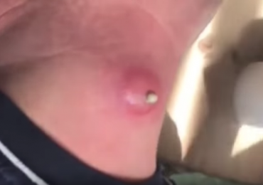 A Massive cyst popping on the neck
