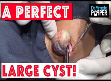 A Perfect Egg-Shaped Epidermoid Cyst