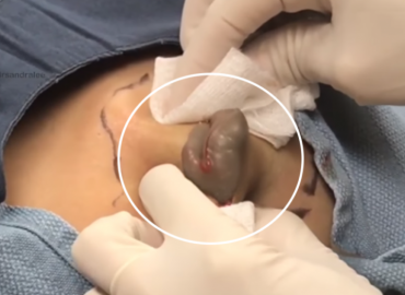 An Amazing Cyst Removed By Dr Pimple Popper