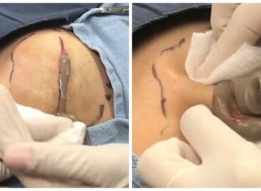 The revolting moment Dr Pimple Popper squeezes thick grey pus 