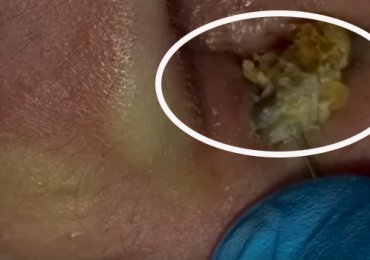 Best of Blackheads extraction