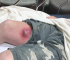 Big Cyst Abscess Drainage from the athlete leg
