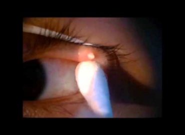 Big pimple popping removal on Eye