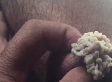 Big Zit and Cyst & Pimple Popping