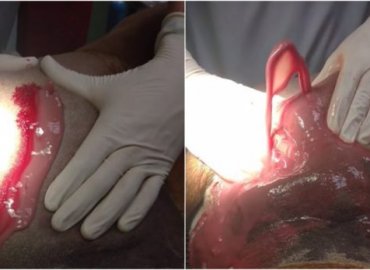 Biggest and best abscess
