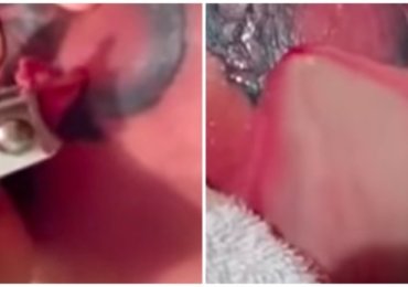 Biggest cyst explosion ever must see !!