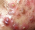 Blackhead Extractions in a Teenager with Acne