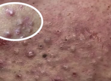 Blackheads and cystic acne removal