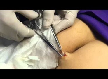 Butt Cyst Removal