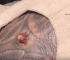 C’mon now, This is a Cute Pilar Cyst!! 