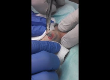 Cyst as hard as marble explodes