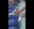Cyst as hard as marble explodes