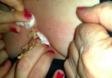 Cyst pimple exolods from mother’s chest 