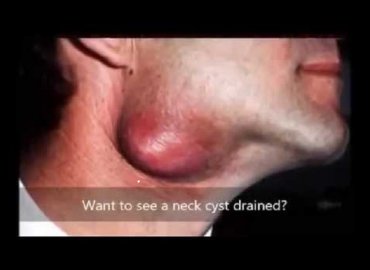 Cyst Removal From Neck