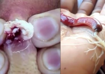 Disgusting! Parasites, zits, insects in people’s ears & more