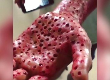 Do You Have Trypophobia or Not?