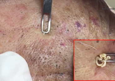 Don’t Miss These Huge Blackhead Extractions