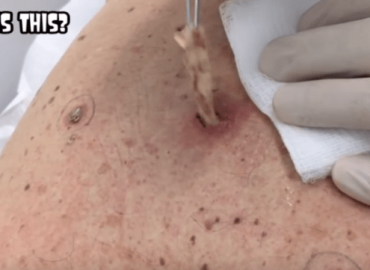 Dozens of Giant Blackheads Popped by Dr. Cyst Buster