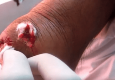 Drainage Of Large Abscess- Elbow Joint 