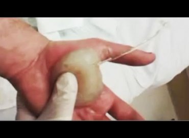 Draining fluid from burned hand