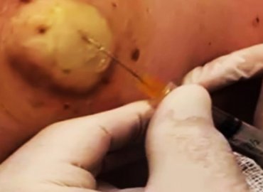 Draining Infected Cyst