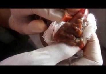 Elbow Cyst Excision