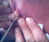 Exploding Ear Cyst