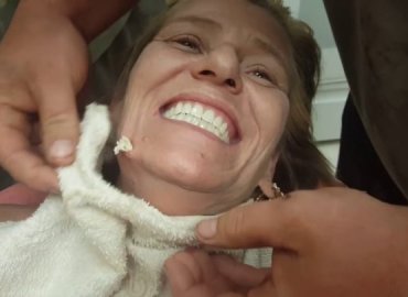 Giant Cyst on my mom face , Removed by me