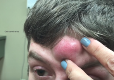 Giant Cyst on the forehead
