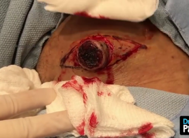 Giant cyst popped as man couldn’t sit down for two weeks