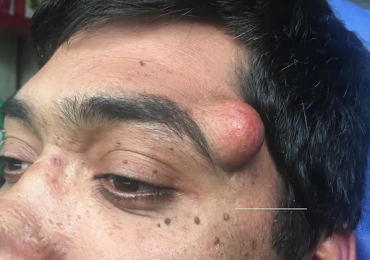 Giant Cyst Removal