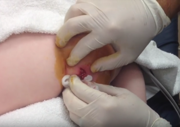 Gluteal Abscess in a Child