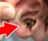 Hearing Loss due to Biggest Earwax – Best Earwax Removal