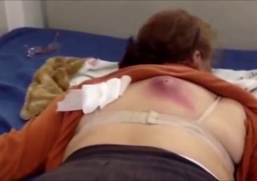 Huge back Cyst removal from mother’s! 