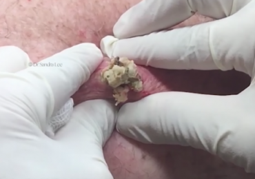 Huge Blackhead, Big Open Cyst, or a Nice Dilated Pore of Winer?