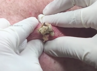 Huge Blackhead, Big Open Cyst, or a Nice Dilated Pore of Winer?