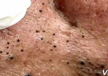 Huge Blackheads Extraction Session