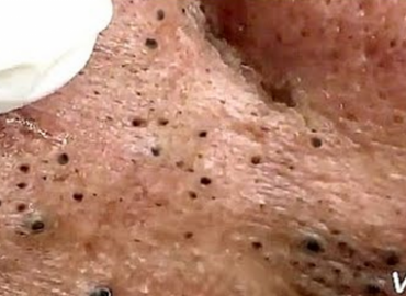 Huge Blackheads Extraction Session