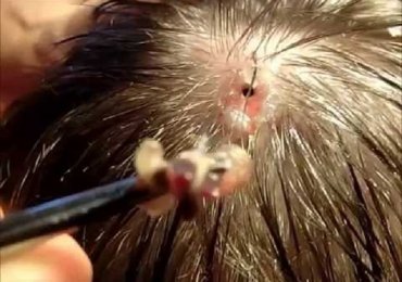 Huge Botfly Removed from Head