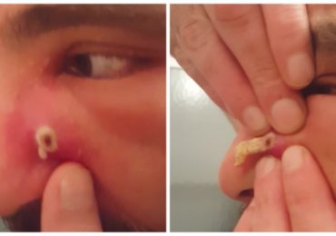 Huge cyst on face exploding